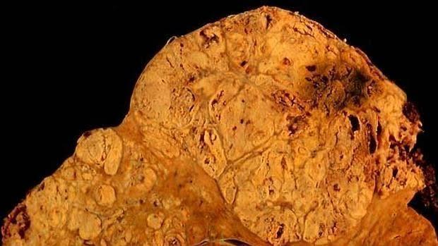 Carcionoma hepatocelular